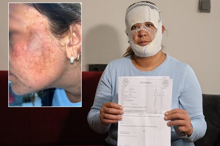 Güzelleşmek uğruna gittiği merkezde yüzü yandı